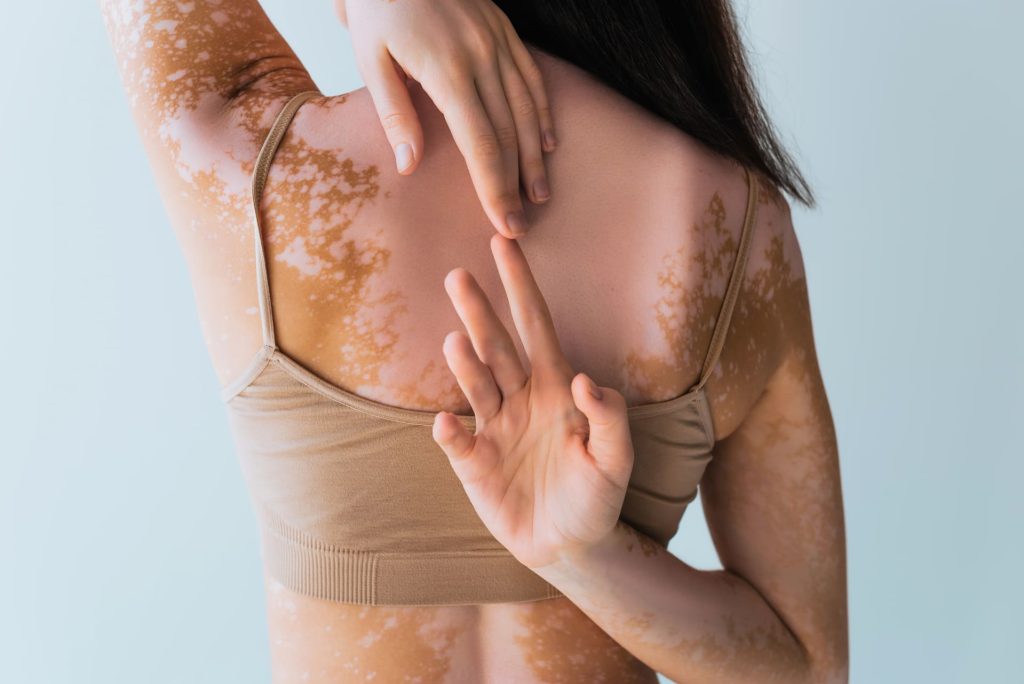 Vitiligo