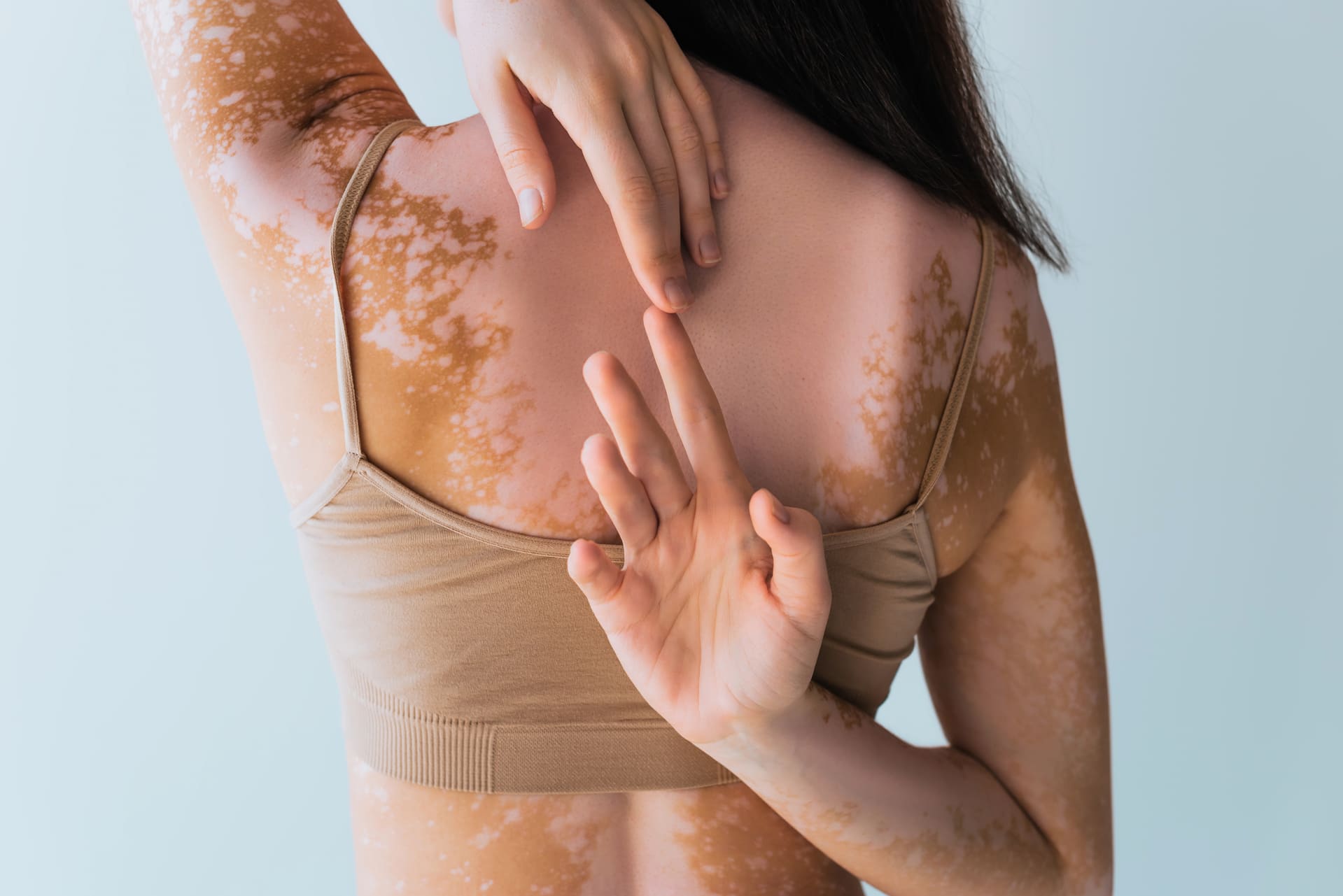 Vitiligo